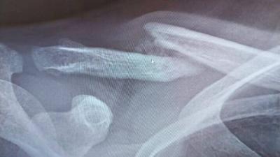 Sleutelbeen fractuur